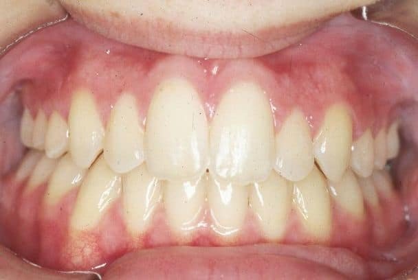 Zgryz krzyżowy – wada zgryzu