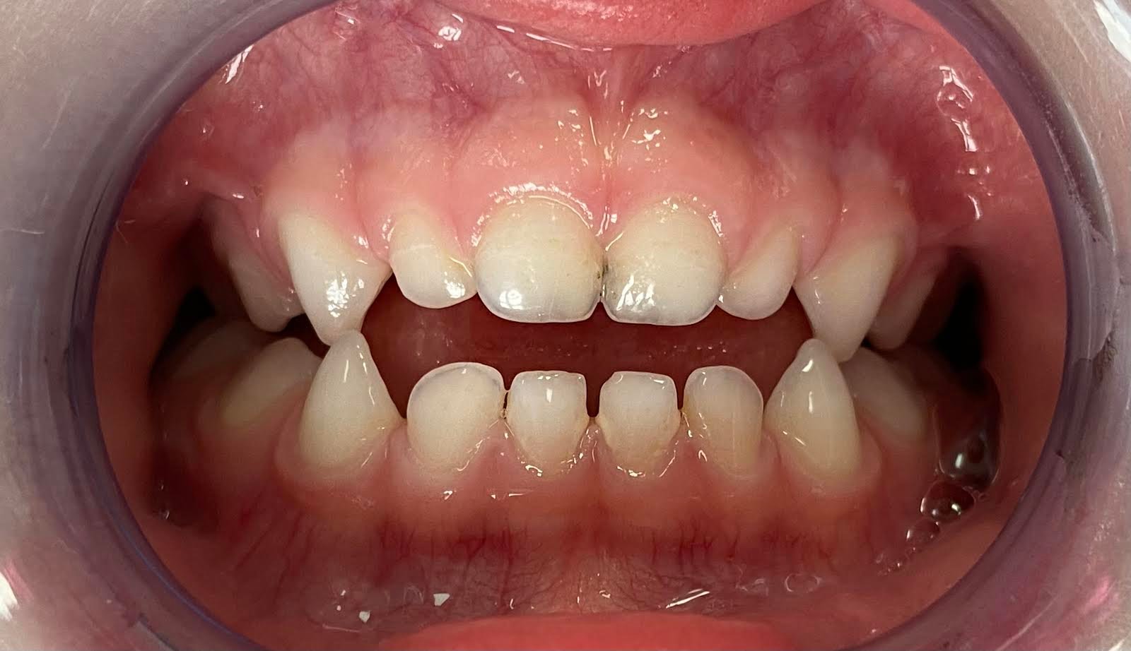 Zgryz otwarty – wada zgryzu