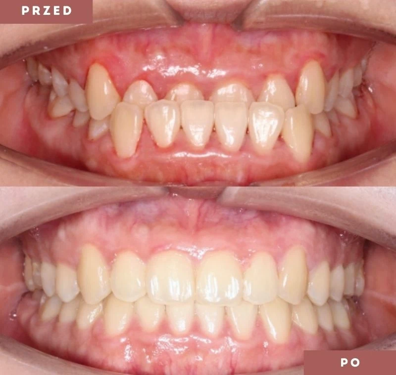 Nakładki Jak Dziala